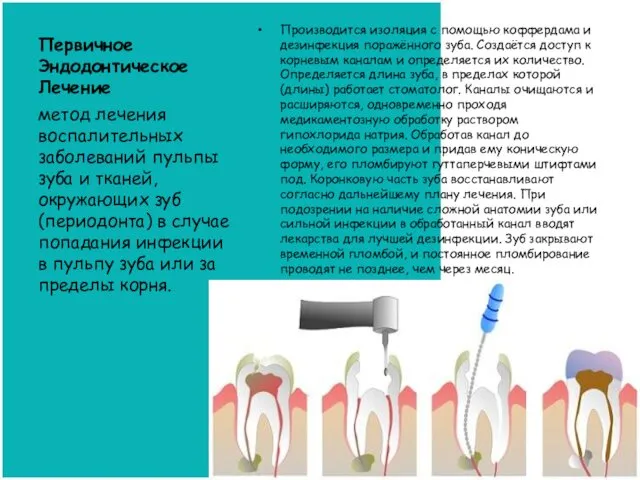 Первичное Эндодонтическое Лечение Производится изоляция с помощью коффердама и дезинфекция