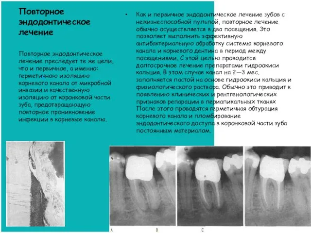 Повторное эндодонтическое лечение Как и первичное эндодонтическое лечение зубов с