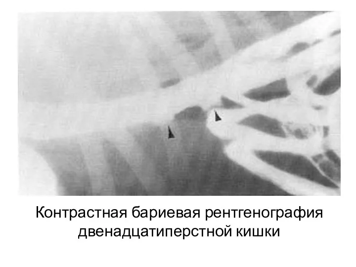 Контрастная бариевая рентгенография двенадцатиперстной кишки