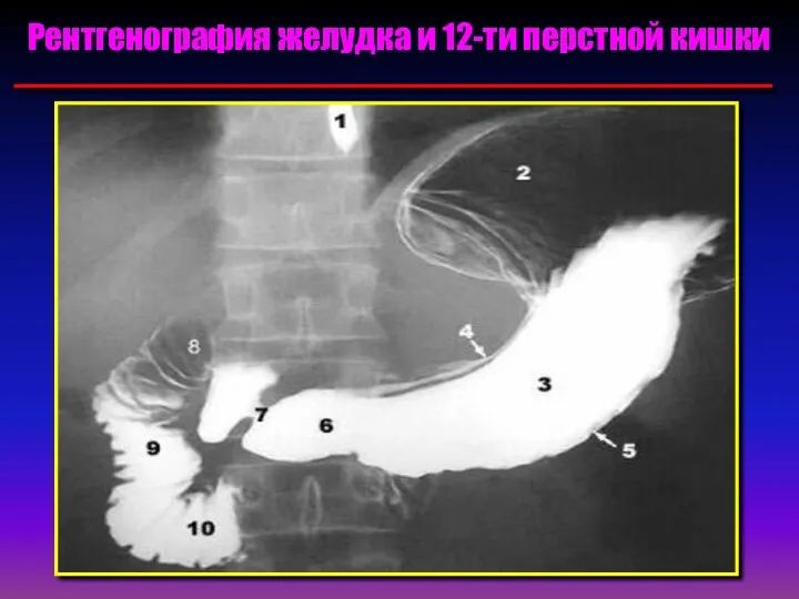 Рентгенография желудка и 12-ти перстной кишки
