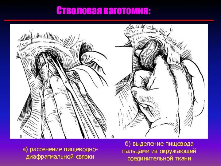 Стволовая ваготомия: а) рассечение пищеводно-диафрагмальной связки б) выделение пищевода пальцами из окружающей соединительной ткани