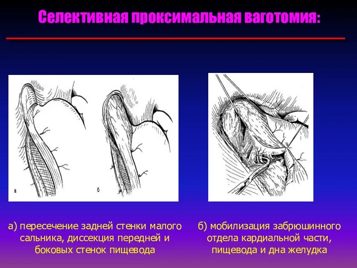 Селективная проксимальная ваготомия: а) пересечение задней стенки малого сальника, диссекция передней и боковых