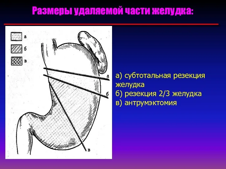 Размеры удаляемой части желудка: а) субтотальная резекция желудка б) резекция 2/3 желудка в) антрумэктомия