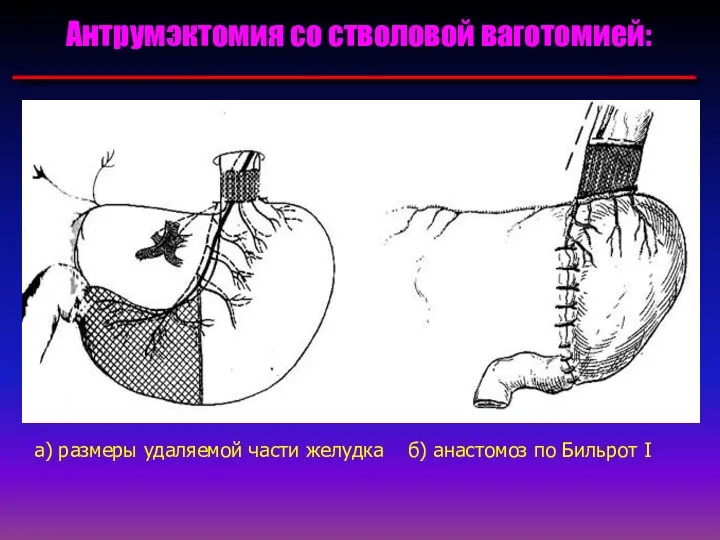Антрумэктомия со стволовой ваготомией: а) размеры удаляемой части желудка б) анастомоз по Бильрот I