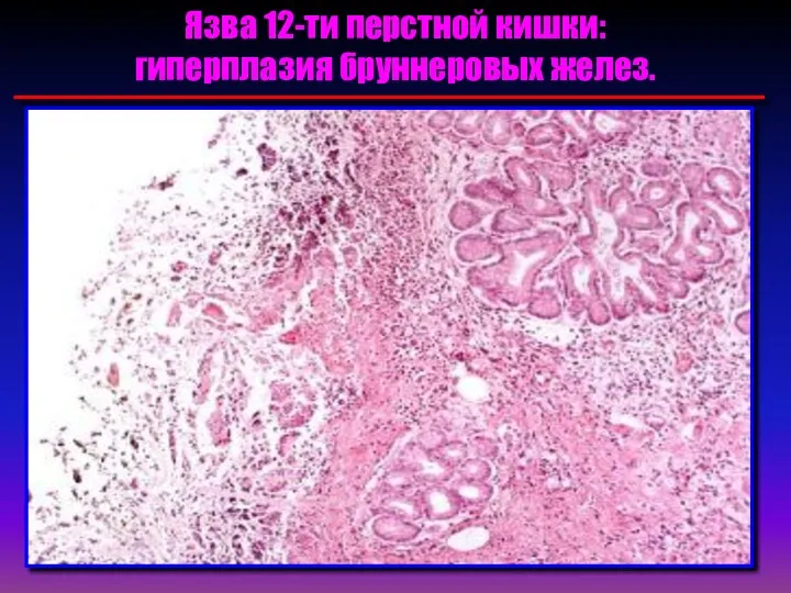 Язва 12-ти перстной кишки: гиперплазия бруннеровых желез.