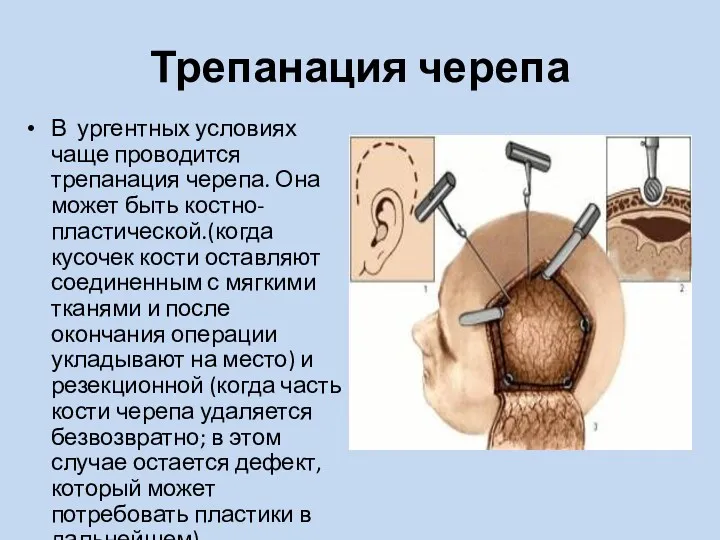 Трепанация черепа В ургентных условиях чаще проводится трепанация черепа. Она