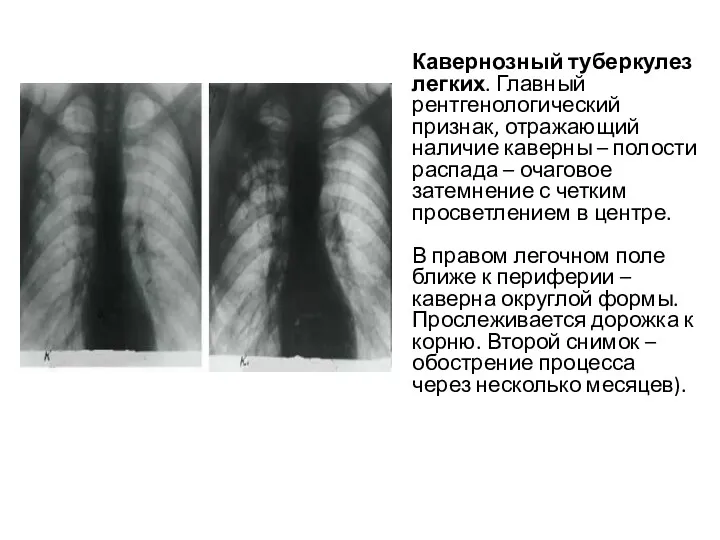 Кавернозный туберкулез легких. Главный рентгенологический признак, отражающий наличие каверны –