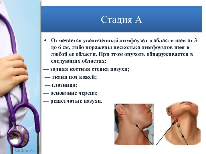 Стадия А Отмечается увеличенный лимфоузел в области шеи от 3