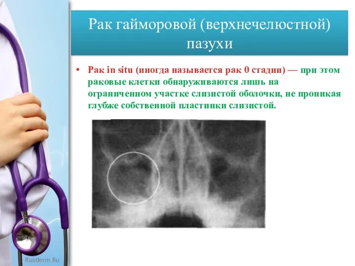 Рак гайморовой (верхнечелюстной) пазухи Рак in situ (иногда называется рак