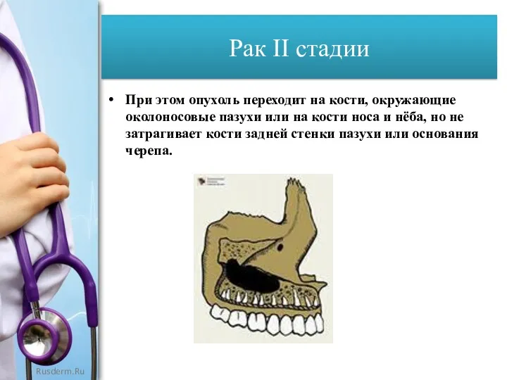 Рак II стадии При этом опухоль переходит на кости, окружающие