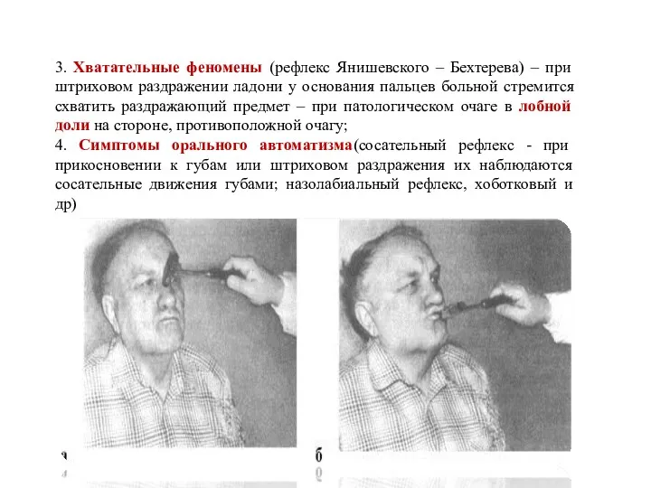 3. Хватательные феномены (рефлекс Янишевского – Бехтерева) – при штриховом