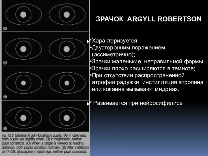 ЗРАЧОК ARGYLL ROBERTSON Характеризуется: Двусторонним поражением (ассиметрично); Зрачки маленькие, неправильной