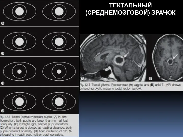 ТЕКТАЛЬНЫЙ(СРЕДНЕМОЗГОВОЙ) ЗРАЧОК