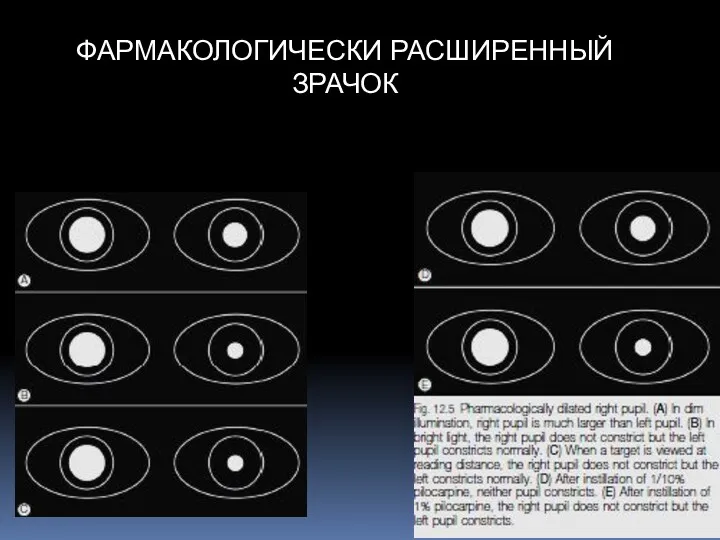 ФАРМАКОЛОГИЧЕСКИ РАСШИРЕННЫЙ ЗРАЧОК