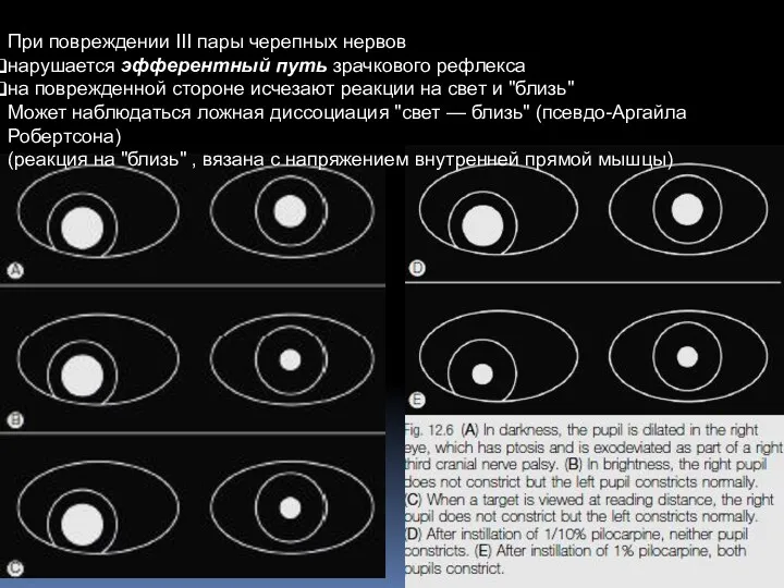 При повреждении III пары черепных нервов нарушается эфферентный путь зрачкового