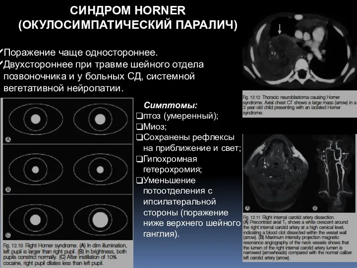 СИНДРОМ HORNER (ОКУЛОСИМПАТИЧЕСКИЙ ПАРАЛИЧ) Поражение чаще одностороннее. Двухстороннее при травме