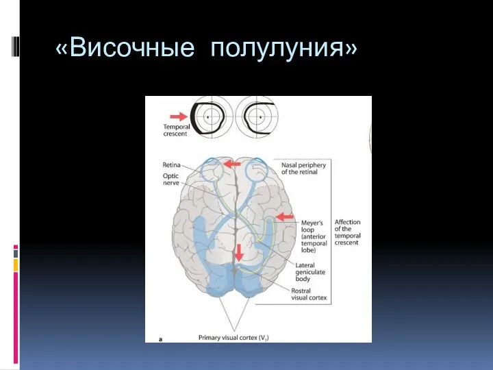 «Височные полулуния»