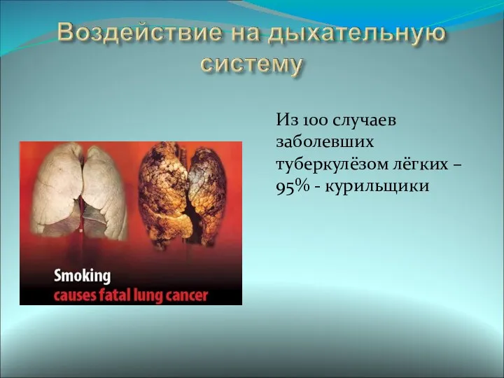 Из 100 случаев заболевших туберкулёзом лёгких – 95% - курильщики