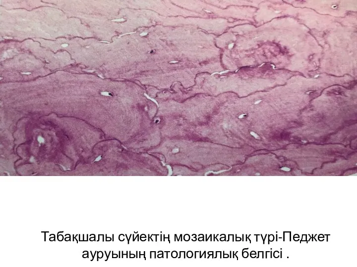 Табақшалы сүйектің мозаикалық түрі-Педжет ауруының патологиялық белгісі .