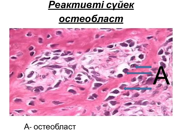 Реактивті сүйек остеобласт А- остеобласт А