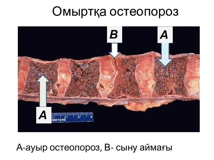 Омыртқа остеопороз А-ауыр остеопороз, В- сыну аймағы А А В