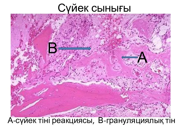 Сүйек сынығы А-сүйек тіні реакциясы, В-грануляциялық тін А В