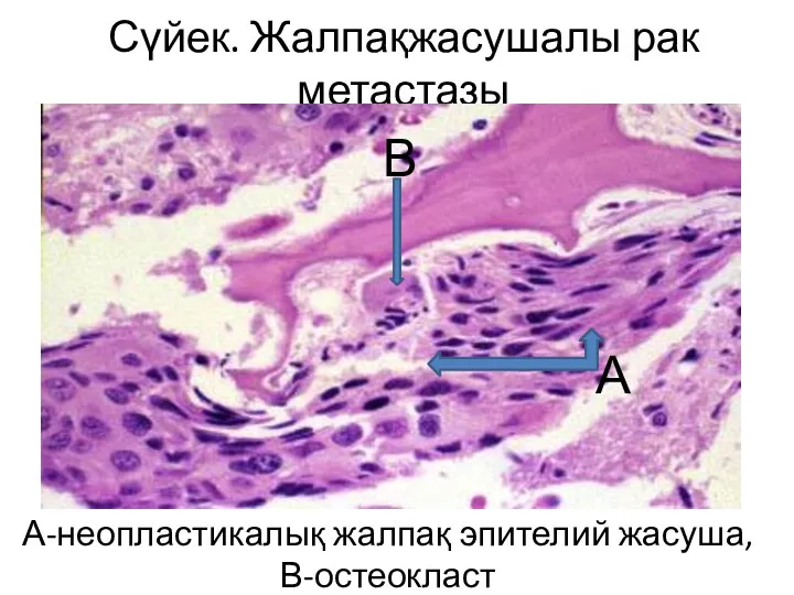 Сүйек. Жалпақжасушалы рак метастазы А-неопластикалық жалпақ эпителий жасуша, В-остеокласт А В