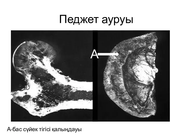 Педжет ауруы А-бас сүйек тігісі қалыңдауы А