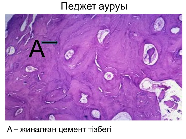 Педжет ауруы А – жиналған цемент тізбегі А