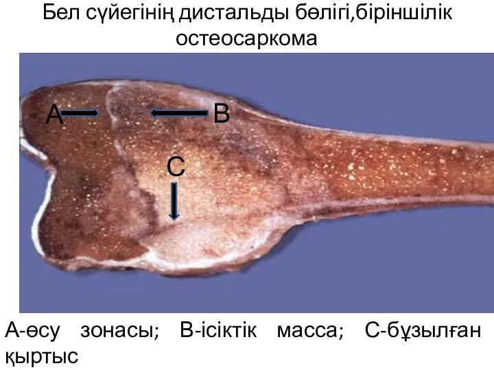 Бел сүйегінің дистальды бөлігі,біріншілік остеосаркома А-өсу зонасы; В-ісіктік масса; С-бұзылған қыртыс А В С
