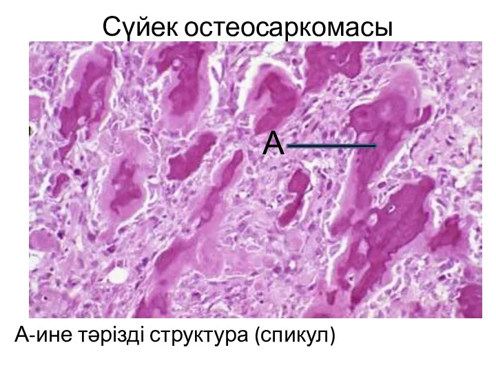 Сүйек остеосаркомасы А-ине тәрізді структура (спикул) А