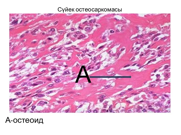 Сүйек остеосаркомасы А-остеоид А