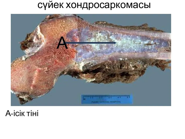 сүйек хондросаркомасы А-ісік тіні А