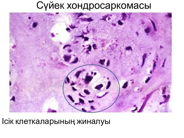 Сүйек хондросаркомасы Ісік клеткаларының жиналуы