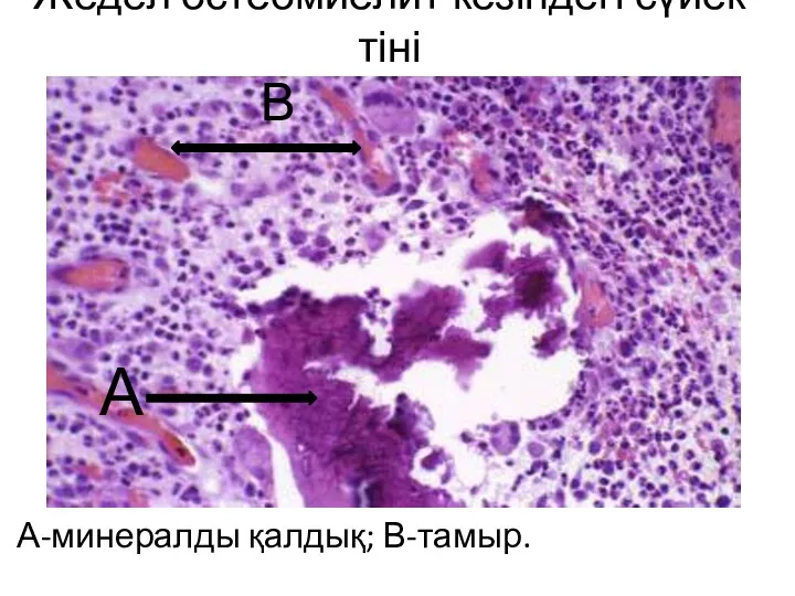 Жедел остеомиелит кезіндегі сүйек тіні А-минералды қалдық; В-тамыр. А В