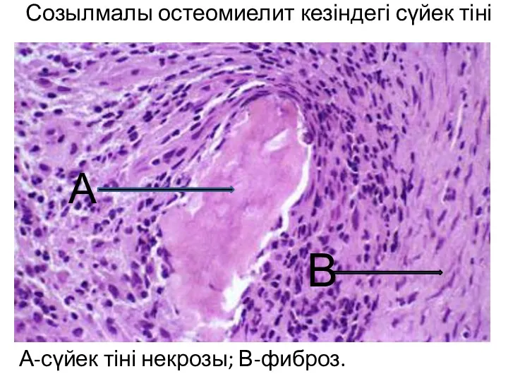 Созылмалы остеомиелит кезіндегі сүйек тіні А-сүйек тіні некрозы; В-фиброз. В А