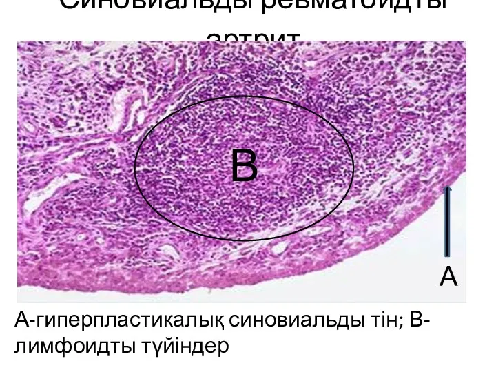 Синовиальды ревматоидты артрит А-гиперпластикалық синовиальды тін; В-лимфоидты түйіндер А В