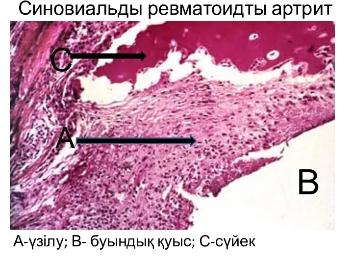 Синовиальды ревматоидты артрит А-үзілу; В- буындық қуыс; С-сүйек А В С