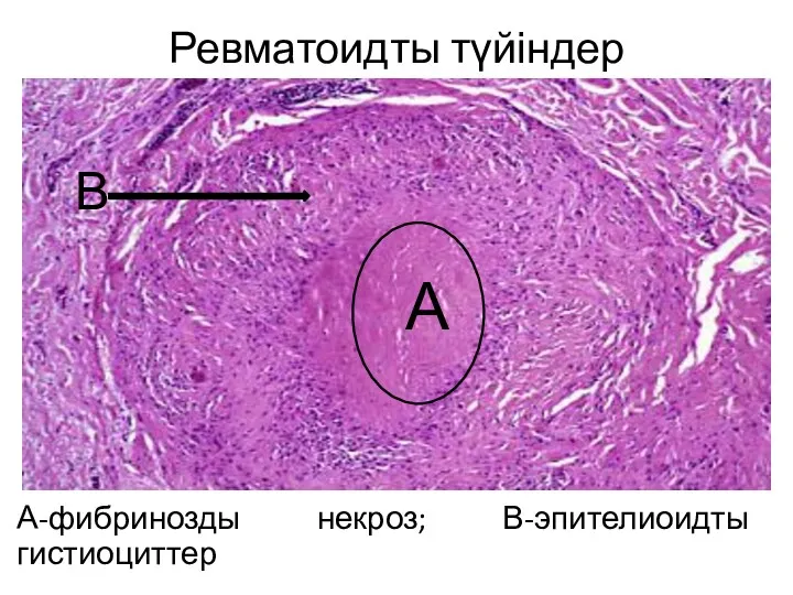 Ревматоидты түйіндер А-фибринозды некроз; В-эпителиоидты гистиоциттер А В