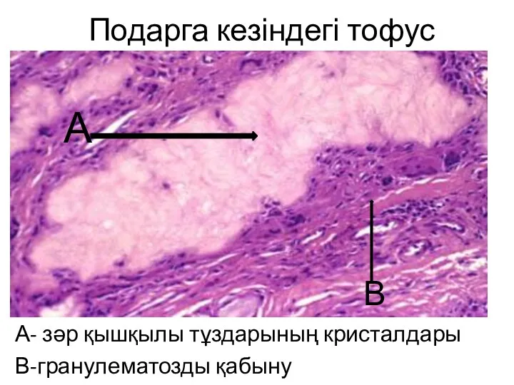 Подарга кезіндегі тофус А- зәр қышқылы тұздарының кристалдары В-гранулематозды қабыну В А