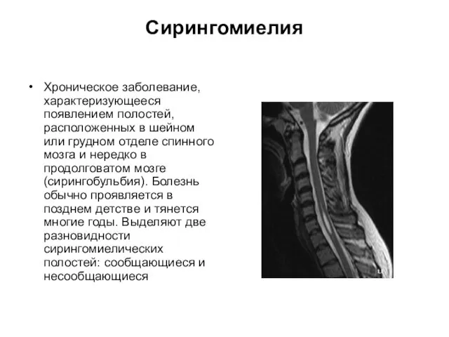 Сирингомиелия Хроническое заболевание, характеризующееся появлением полостей, расположенных в шейном или грудном отделе спинного