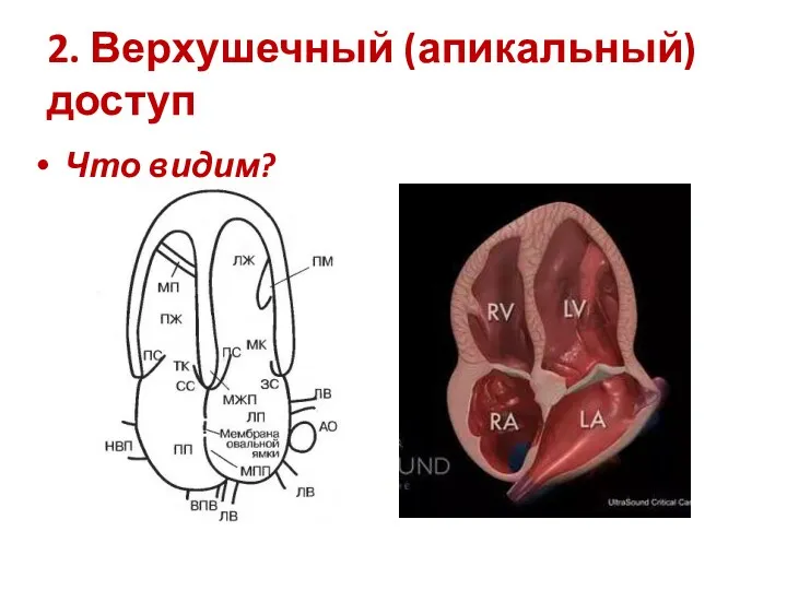 2. Верхушечный (апикальный) доступ Что видим?