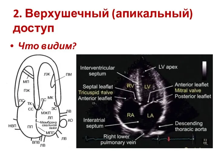 2. Верхушечный (апикальный) доступ Что видим?