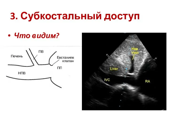 3. Субкостальный доступ Что видим?