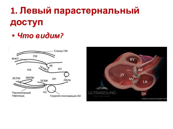 1. Левый парастернальный доступ Что видим?