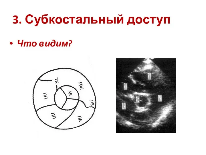 3. Субкостальный доступ Что видим?