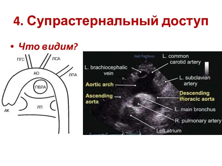 4. Супрастернальный доступ Что видим?