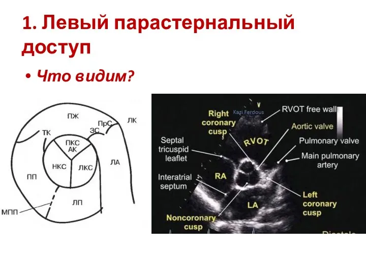 1. Левый парастернальный доступ Что видим?