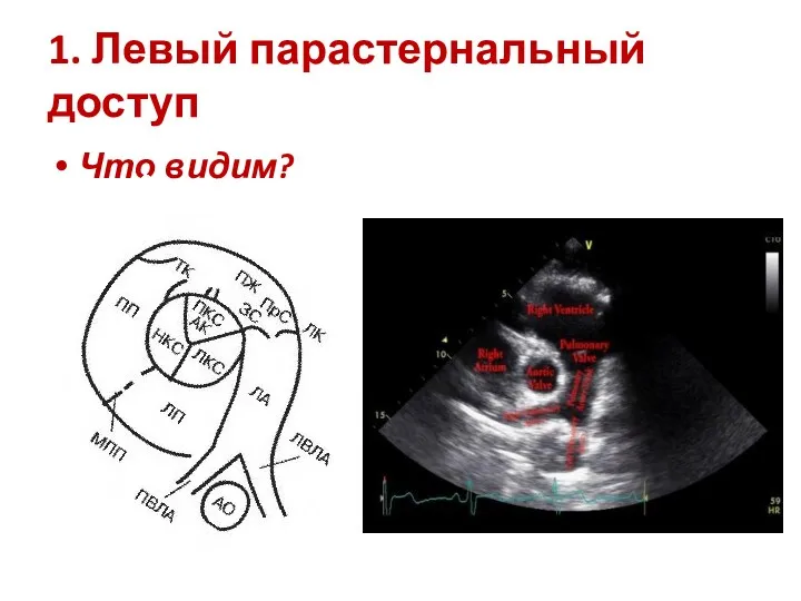 1. Левый парастернальный доступ Что видим?