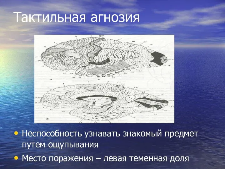 Тактильная агнозия Неспособность узнавать знакомый предмет путем ощупывания Место поражения – левая теменная доля